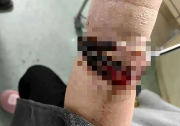 创牛配资 女子手镯10年没摘竟“长”进肉里！医生：再晚点就保不住了
